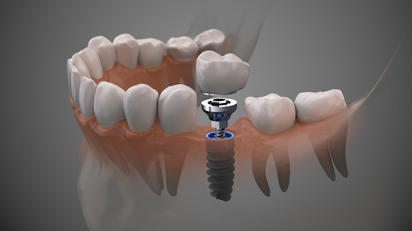 Dental Implants Colleyville, TX