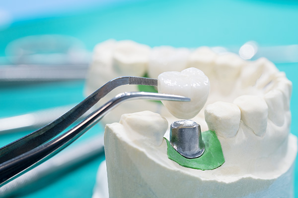General Dentistry Solutions Using Dental Crowns from Dental Studio Colleyville in Colleyville, TX