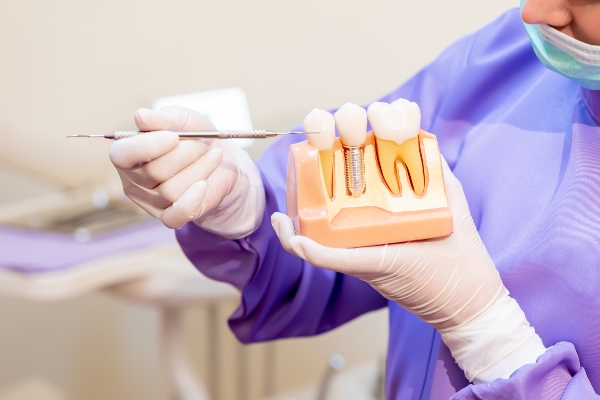 The Potential Risks Of Getting Dental Implants