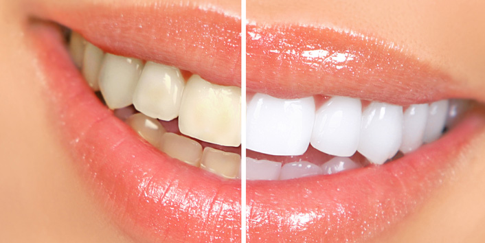 Teeth Whitening Colleyville, TX