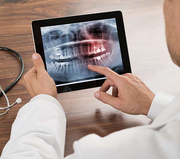 Colleyville Types of Dental Root Fractures